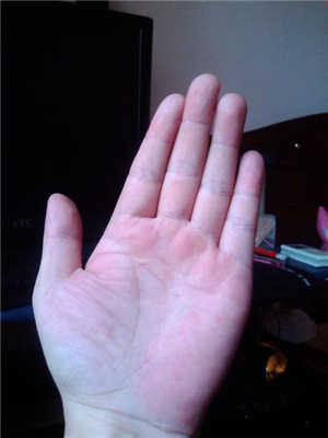 一般我们正常人的手掌表现为淡红色,淡红色为正常的手掌肤色,用